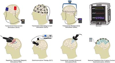 Non-invasive brain stimulation for fibromyalgia: current trends and future perspectives